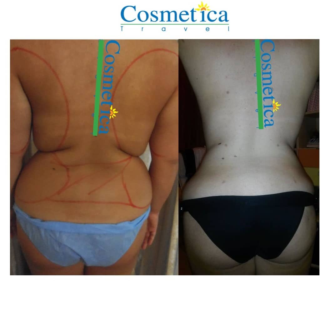 Back lift surgery in Tunisia: bra-line back lift cost- Cosmetica Travel