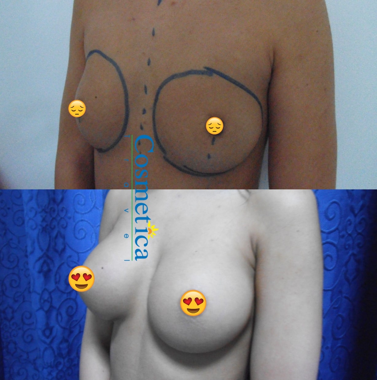 implant seins resultats