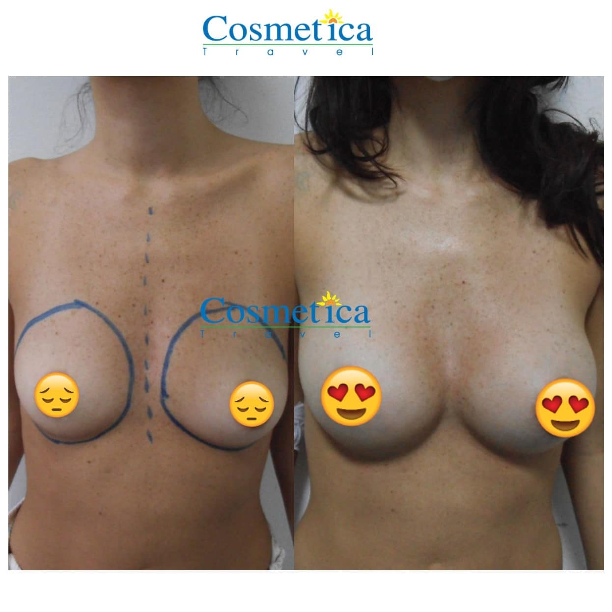 implant mammaire resultat