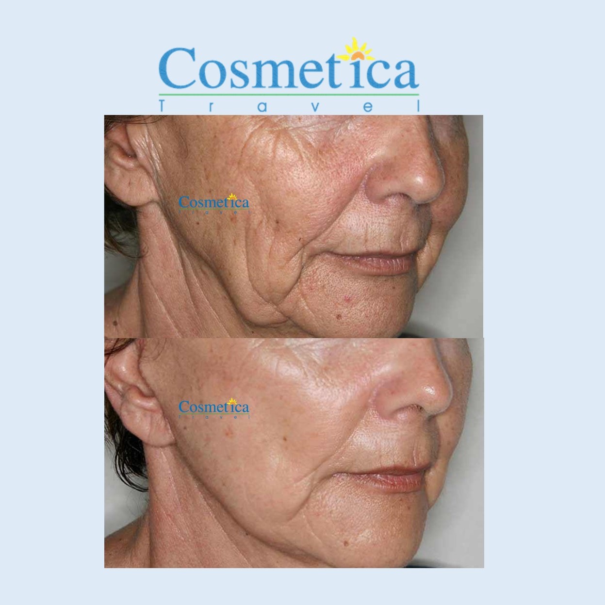 lifting cervico facial avant apres